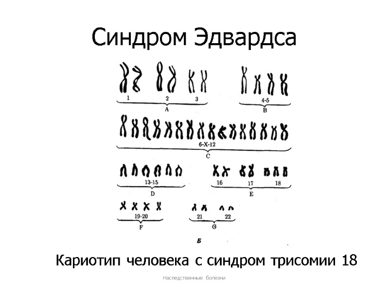 Синдром Эдвардса Наследственные болезни Кариотип человека с синдром трисомии 18